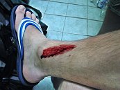 Od přisátí pijavice uplynulo pár hodin, přesto z rány stále teče krev. To je na pijavicích to nejvíc nepříjemné. Ne samotné přisátí, o tom člověk totiž skrz velmi ostré &#34;zoubky&#34; pijavic ani neví. Ale tím, že pijavice po přisátí vpouští do rány látky bránící srážení krve. Krev potom z rány teče pomalinku ale pravidelně i několik hodin, zvláště pokud si člověk nohu ničím neováže, protože o pijavici neví.